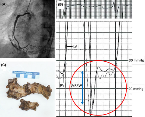 The constrictive consequences of pericardial calcifications