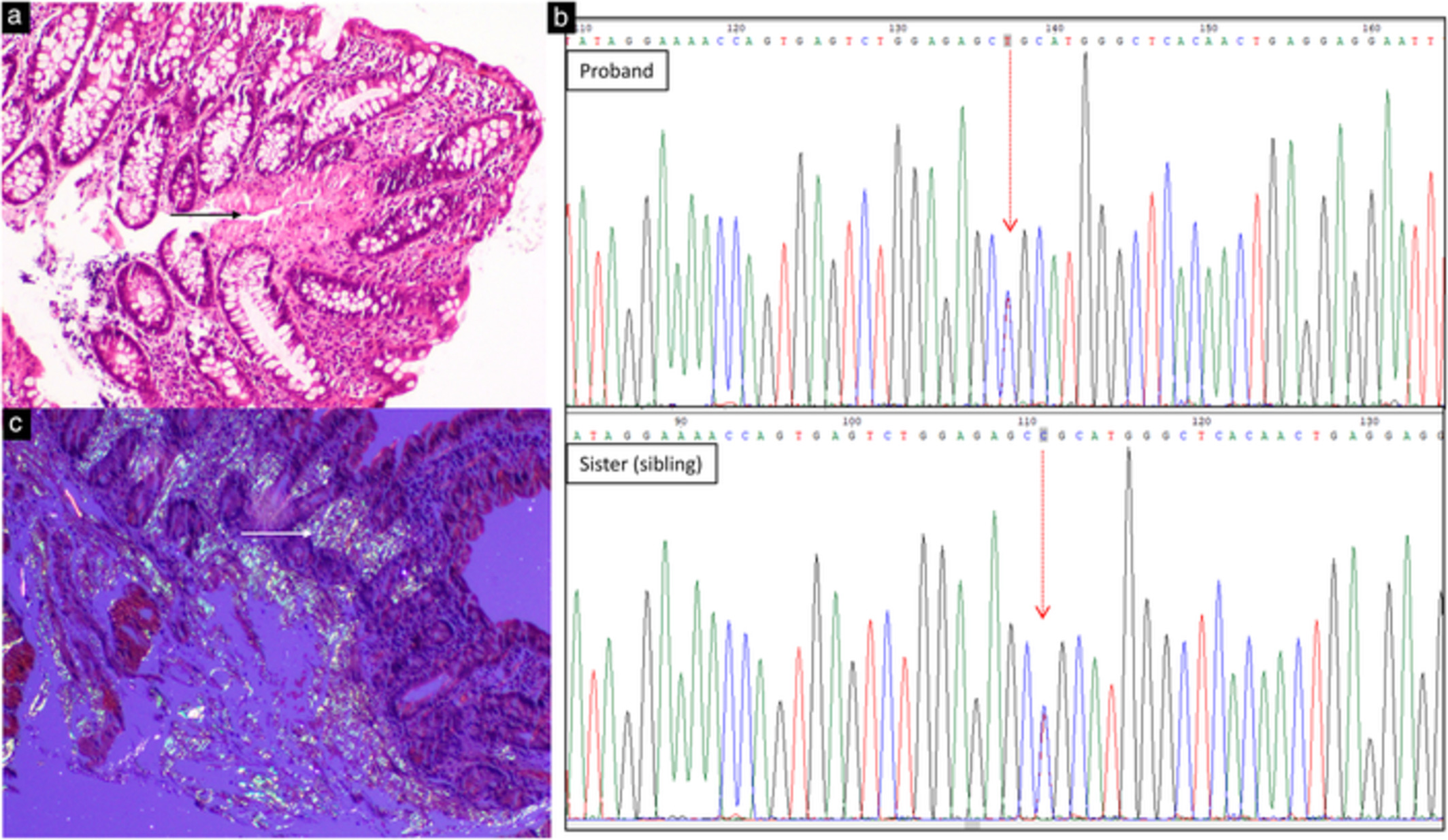 An unusual case of hereditary transthyretin-related amyloidosis and ulcerative colitis in a young Indian girl