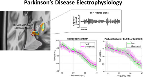 Spectral characteristics of subthalamic nucleus local field potentials in Parkinson's disease: Phenotype and movement matter