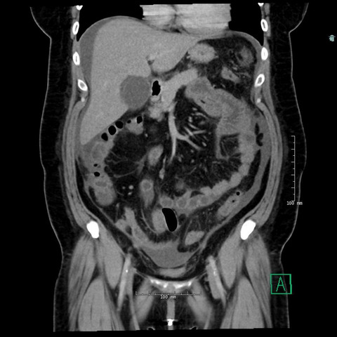 Herpes hepatitis as a complication of total abdominal hysterectomy; an unusual complication of abdominal instrumentation