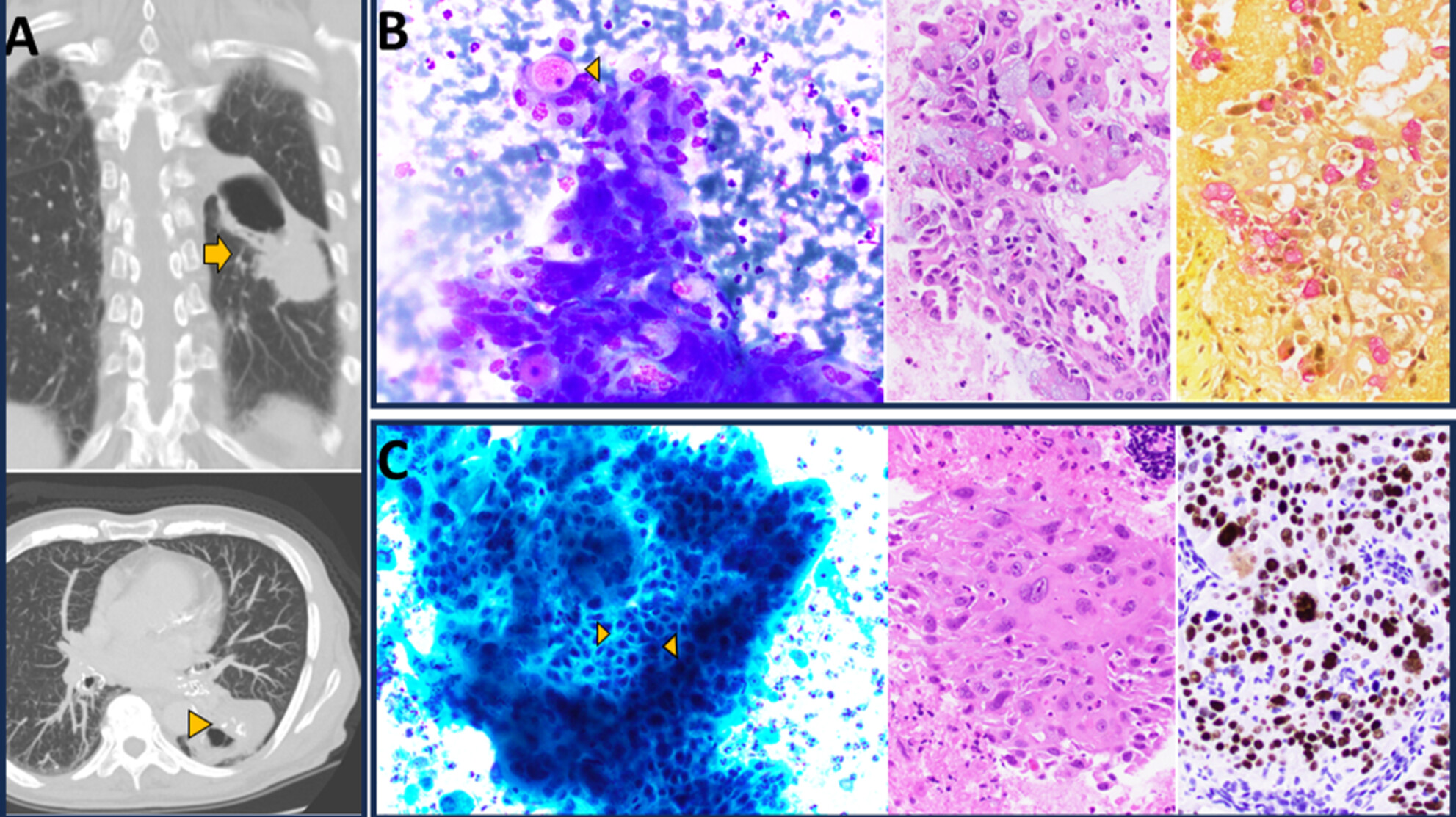 Adenosquamous carcinoma arising within a long-standing intrapulmonary bronchogenic cyst in an adult presenting with hyponatraemia