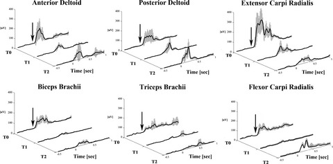 Botulinum toxin A modifies nociceptive withdrawal reflex in subacute stroke patients