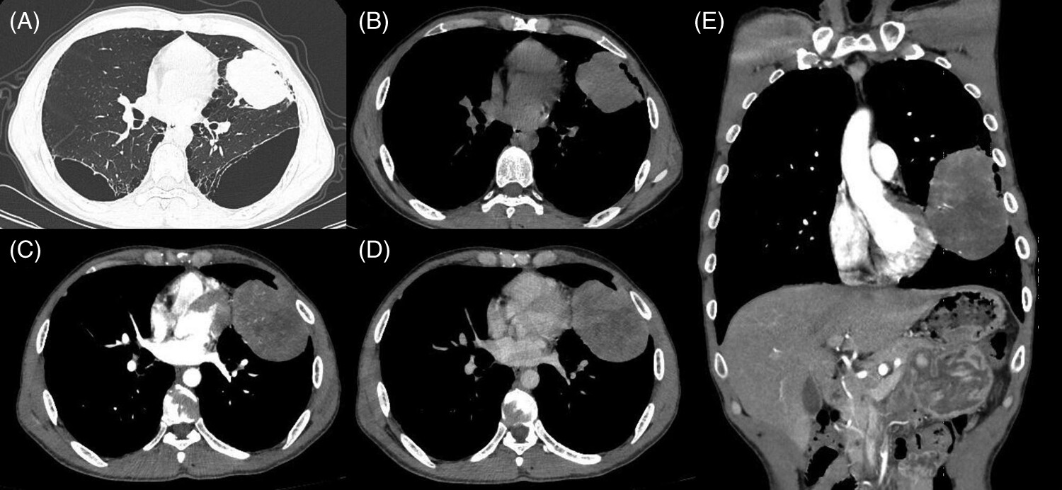 A rare case of hepatoid adenocarcinoma of the lung