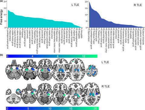 Remodeling of brain morphology in temporal lobe epilepsy