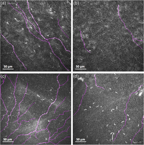 Long-term evaluation of corneal sub-basal nerve recovery after photorefractive keratectomy and influence of pars plana vitrectomy
