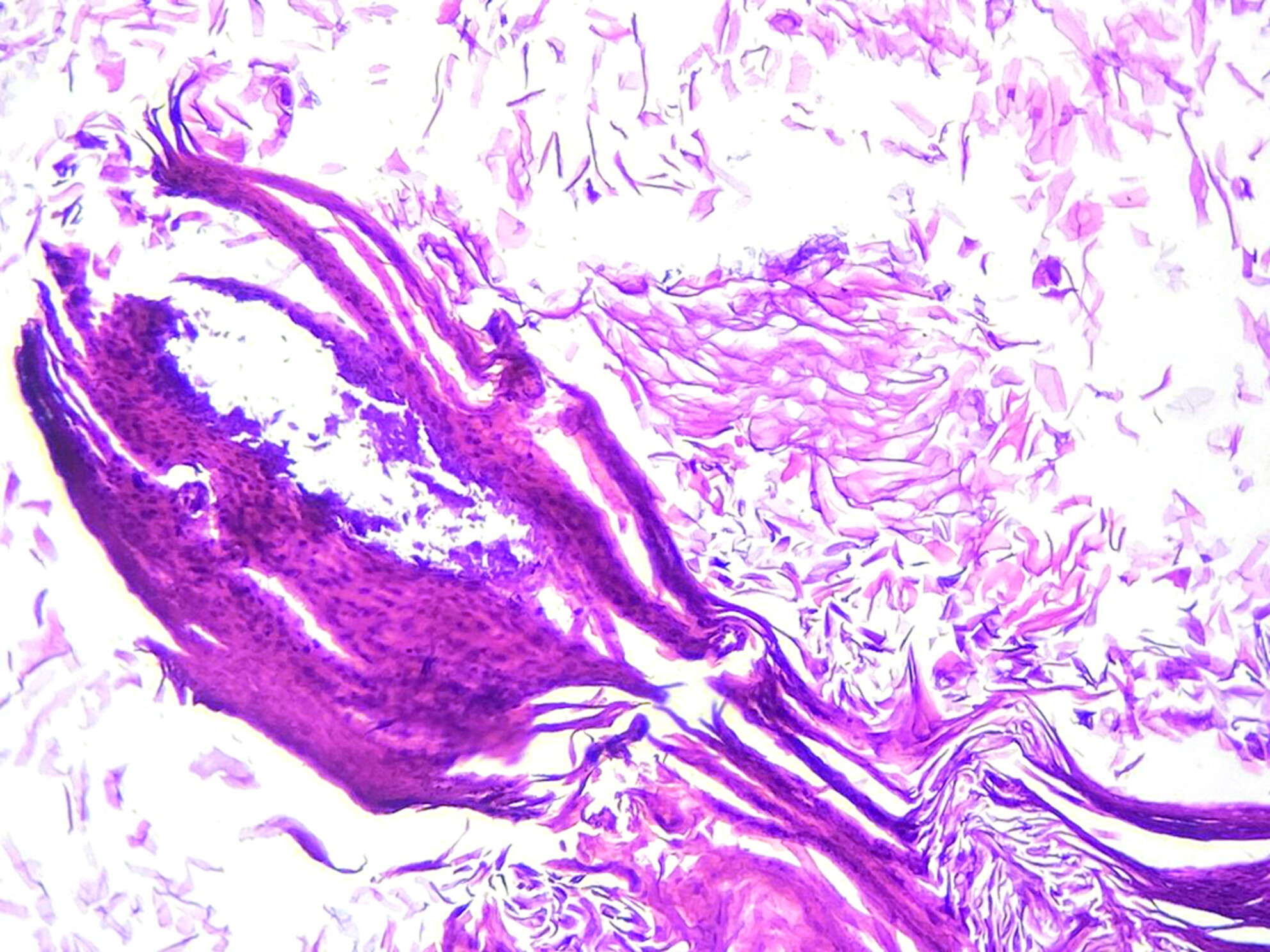 Clinical aspects of middle ear tympanokeratoma in dogs diagnosed through advanced imaging, otoendoscopy and histopathological evaluation