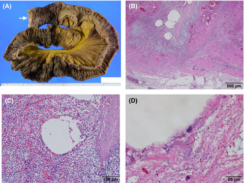 Necrotizing enterocolitis associated with Clostridium butyricum in a Japanese man