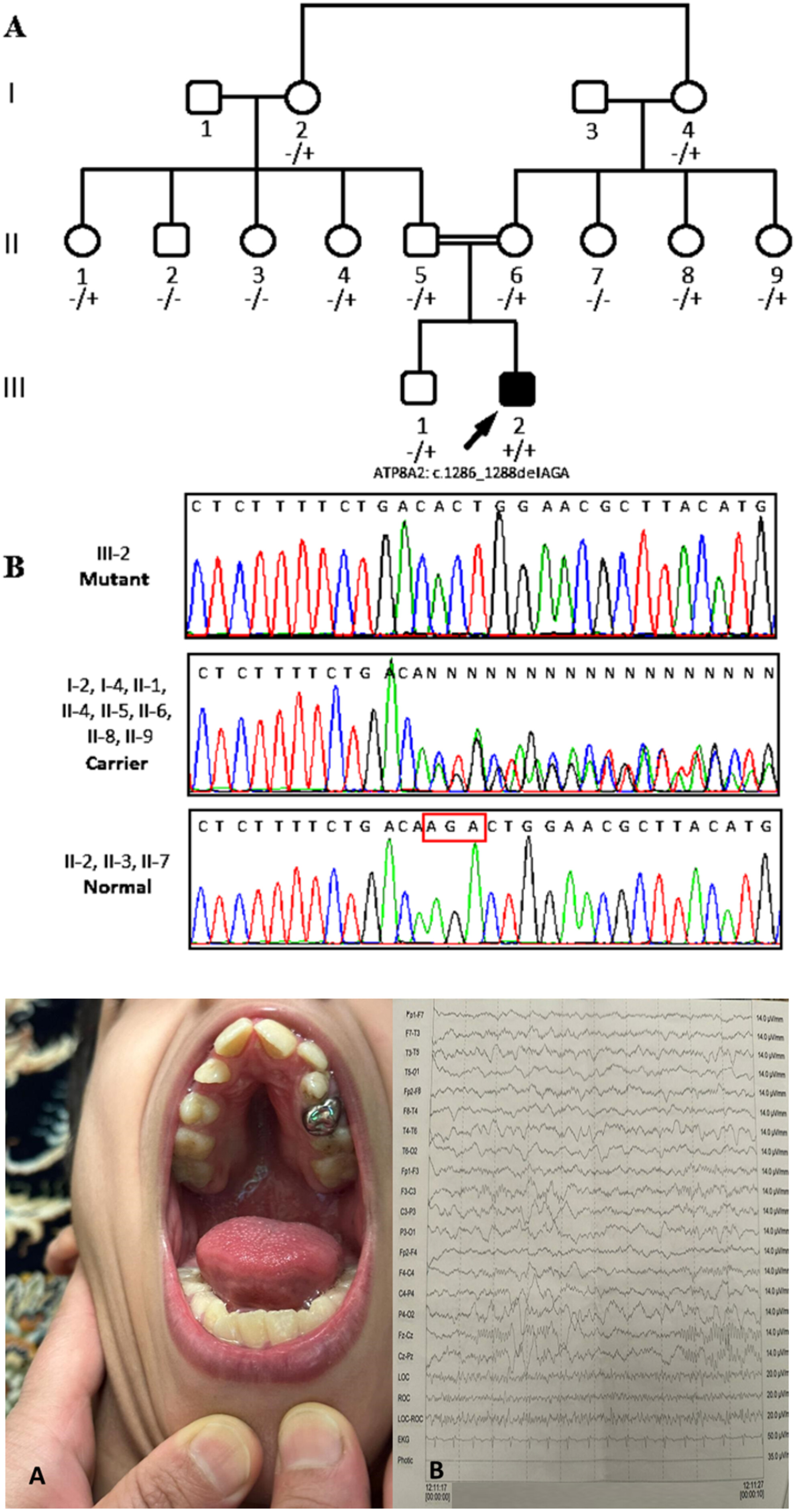 Reevaluation of the Impact of the Novel Likely Pathogenic Variant c.1286_1288delAGA in the ATP8A2 Gene: A 7-Year Follow-Up With Clinical, Genetic, and ACMG Insights in an Iranian Family