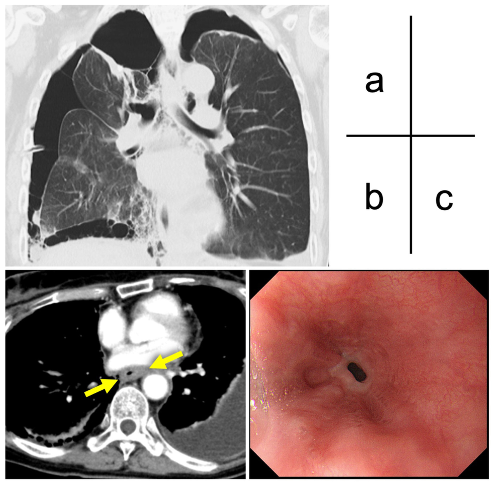 Malignant pleural mesothelioma in a patient with pneumothorax: A cumbersome subtype both clinically and pathologically