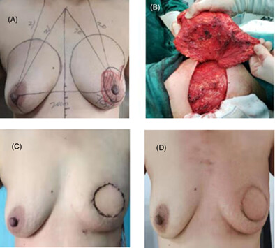 Clinical analysis of immediate breast reconstruction using latissimus dorsi muscular flap in breast cancer