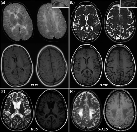 Hypomyelinating leukodystrophies in adults: Clinical and genetic features