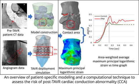 A computational framework for post-TAVR cardiac conduction abnormality (CCA) risk assessment in patient-specific anatomy
