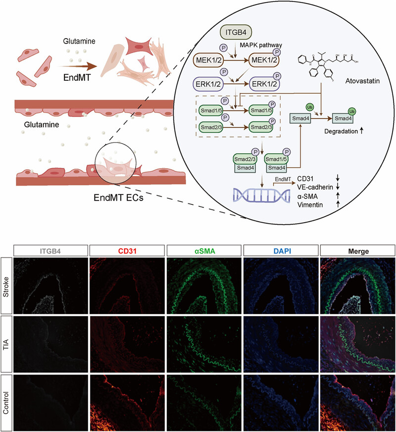 High glutamine increases stroke risk by inducing the endothelial-to-mesenchymal transition in moyamoya disease