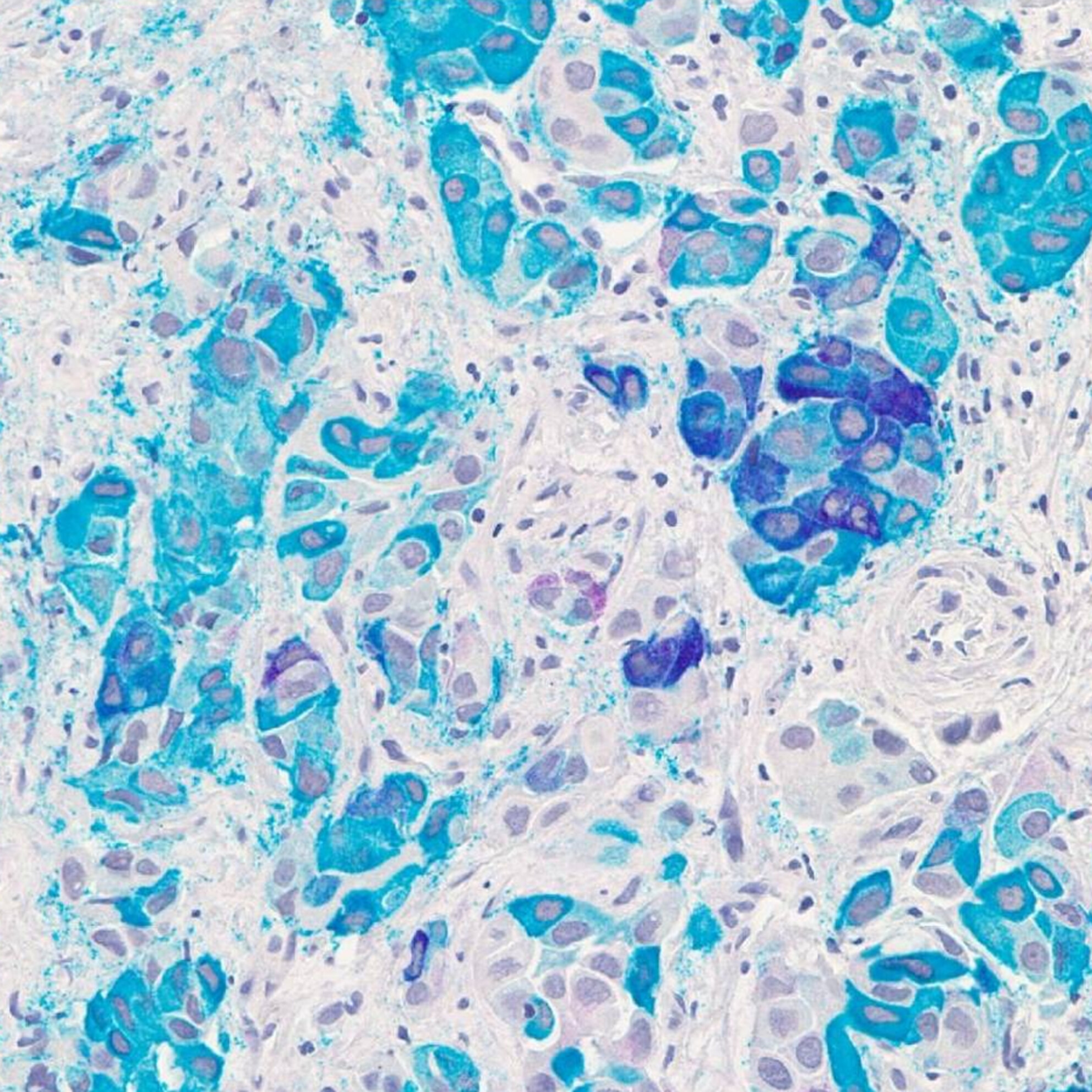 Immunocytochemical markers, molecular testing and digital cytopathology for aspiration cytology of metastatic breast carcinoma