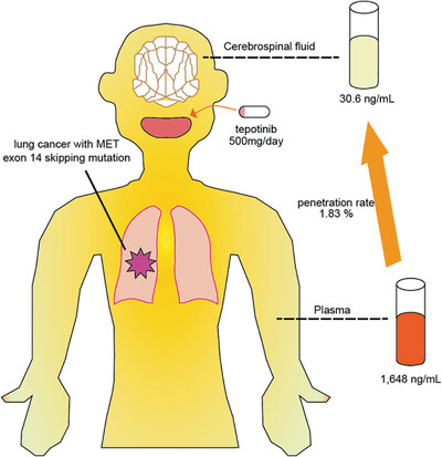 Activity and bioavailability of tepotinib for leptomeningeal metastasis of NSCLC with MET exon 14 skipping mutation