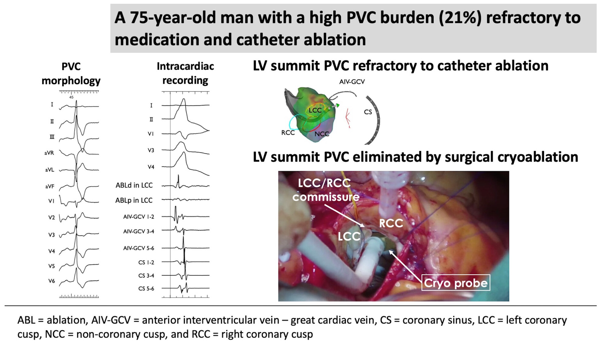 Surgical cryoprobe ablation for premature ventricular contraction of left ventricular summit refractory to catheter ablation