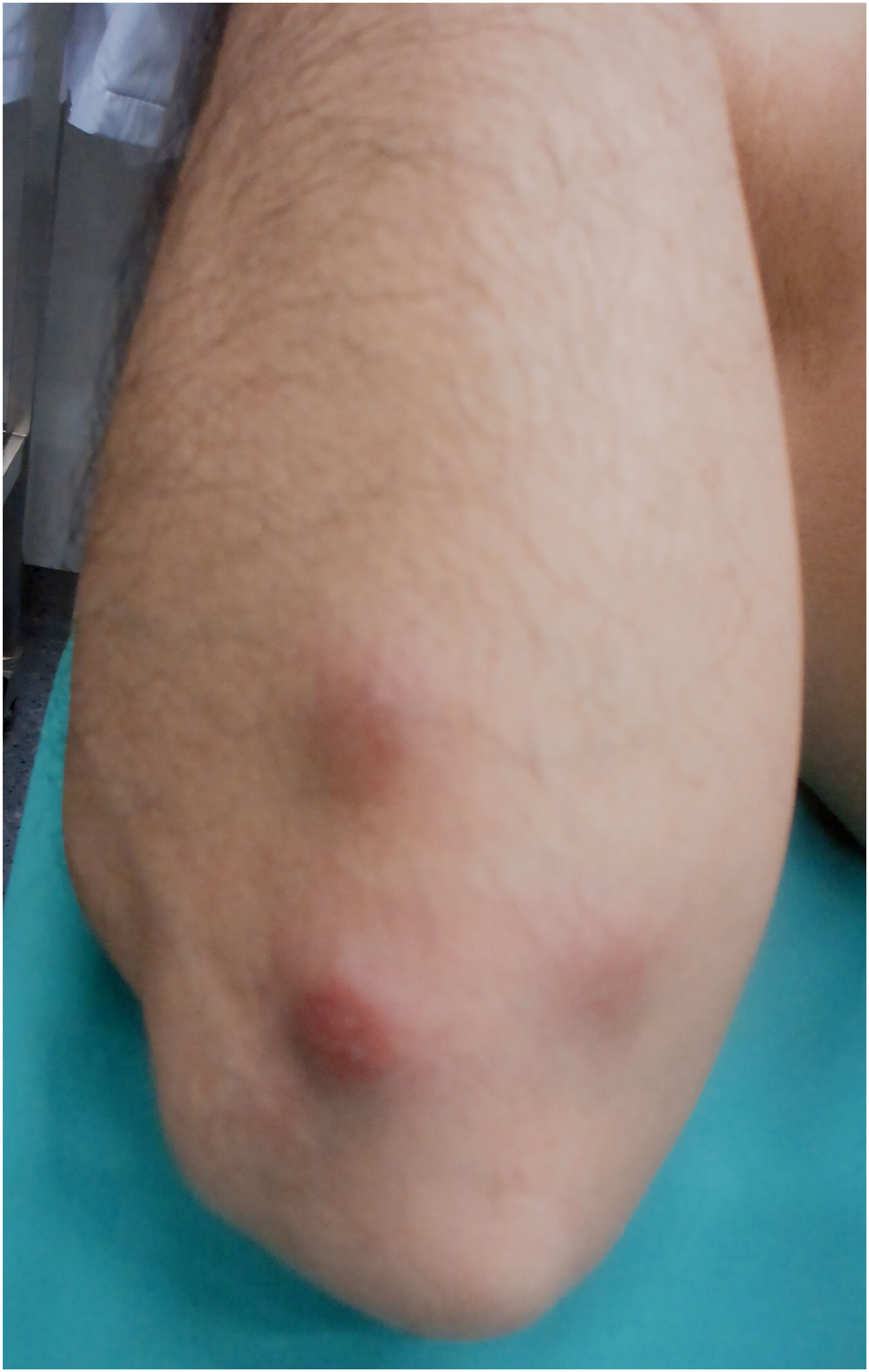 Multilocular subcutaneous bacillary angiomatosis as a primary manifestation of AIDS