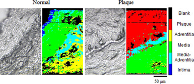 Histological classification of atherosclerotic arteries using high-speed confocal Raman microscopy with machine learning