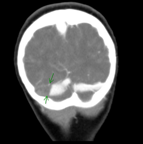 Cerebral sinovenous thrombosis as a complication of otitis media