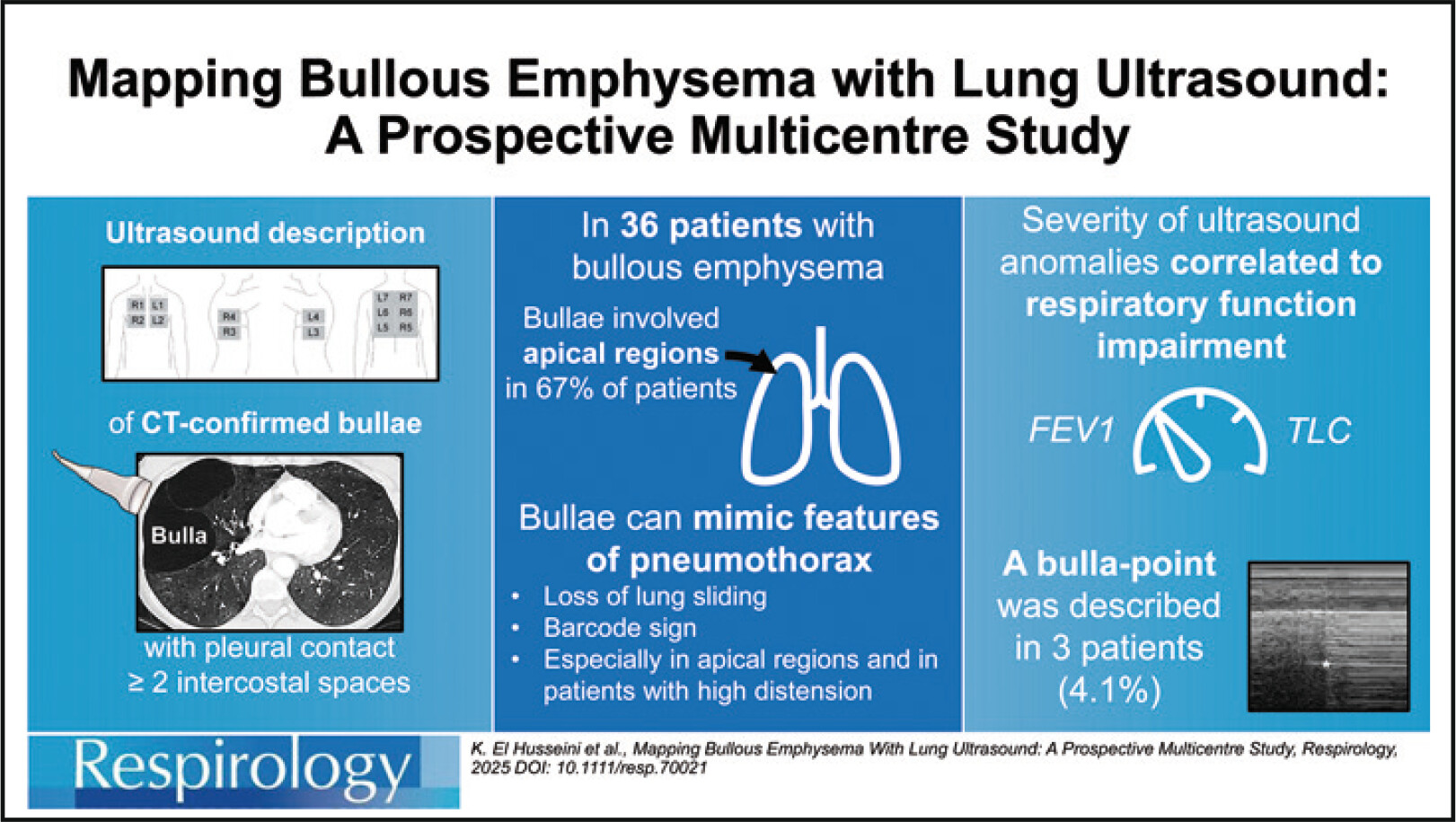 Mapping Bullous Emphysema With Lung Ultrasound: A Prospective Multicentre Study