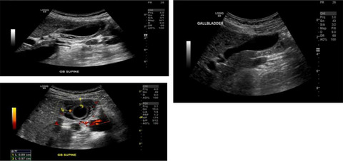Friend or foe—The Pfizer-BioNTech (BNT162b2) vaccination: A case report of reversible acute acalculous cholecystitis