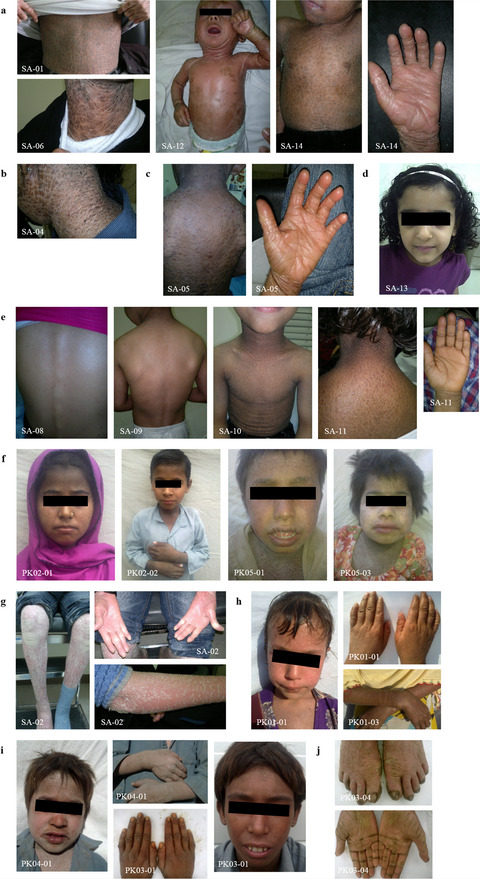 Unknown mutations and genotype/phenotype correlations of autosomal recessive congenital ichthyosis in patients from Saudi Arabia and Pakistan