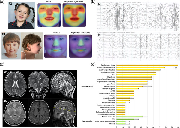 De novo truncating NOVA2 variants affect alternative splicing and lead to heterogeneous neurodevelopmental phenotypes