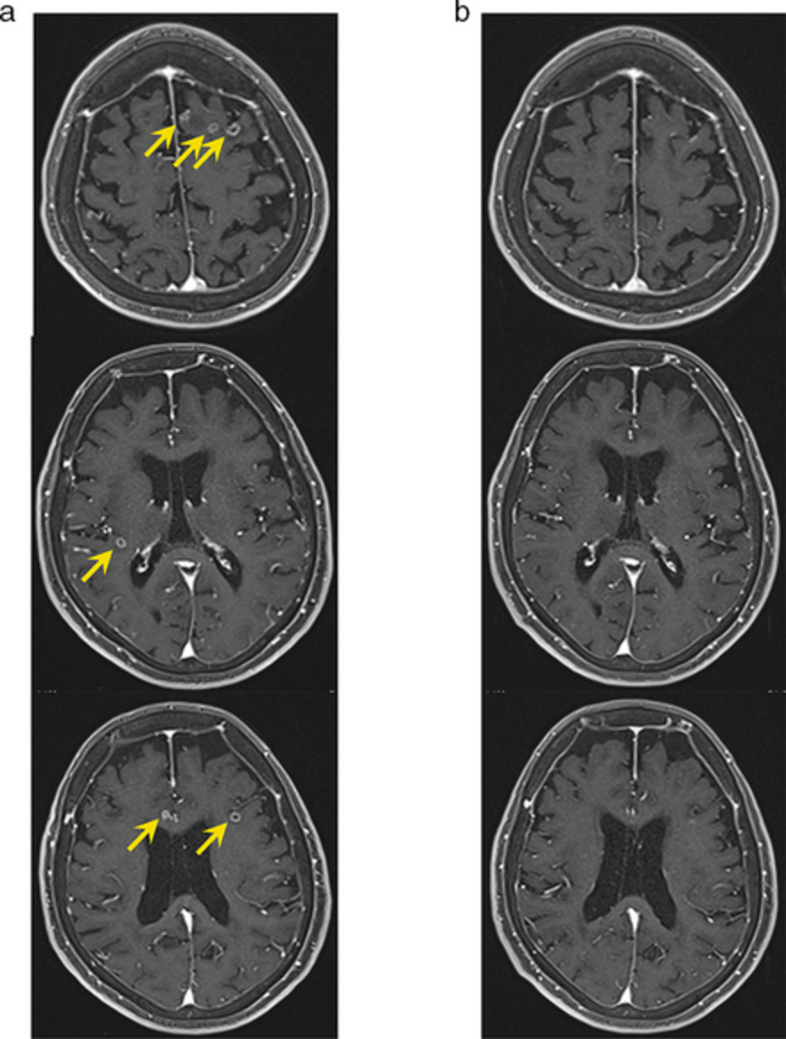 Dramatic intracranial response to tepotinib in a patient with lung adenocarcinoma harboring MET exon 14 skipping mutation