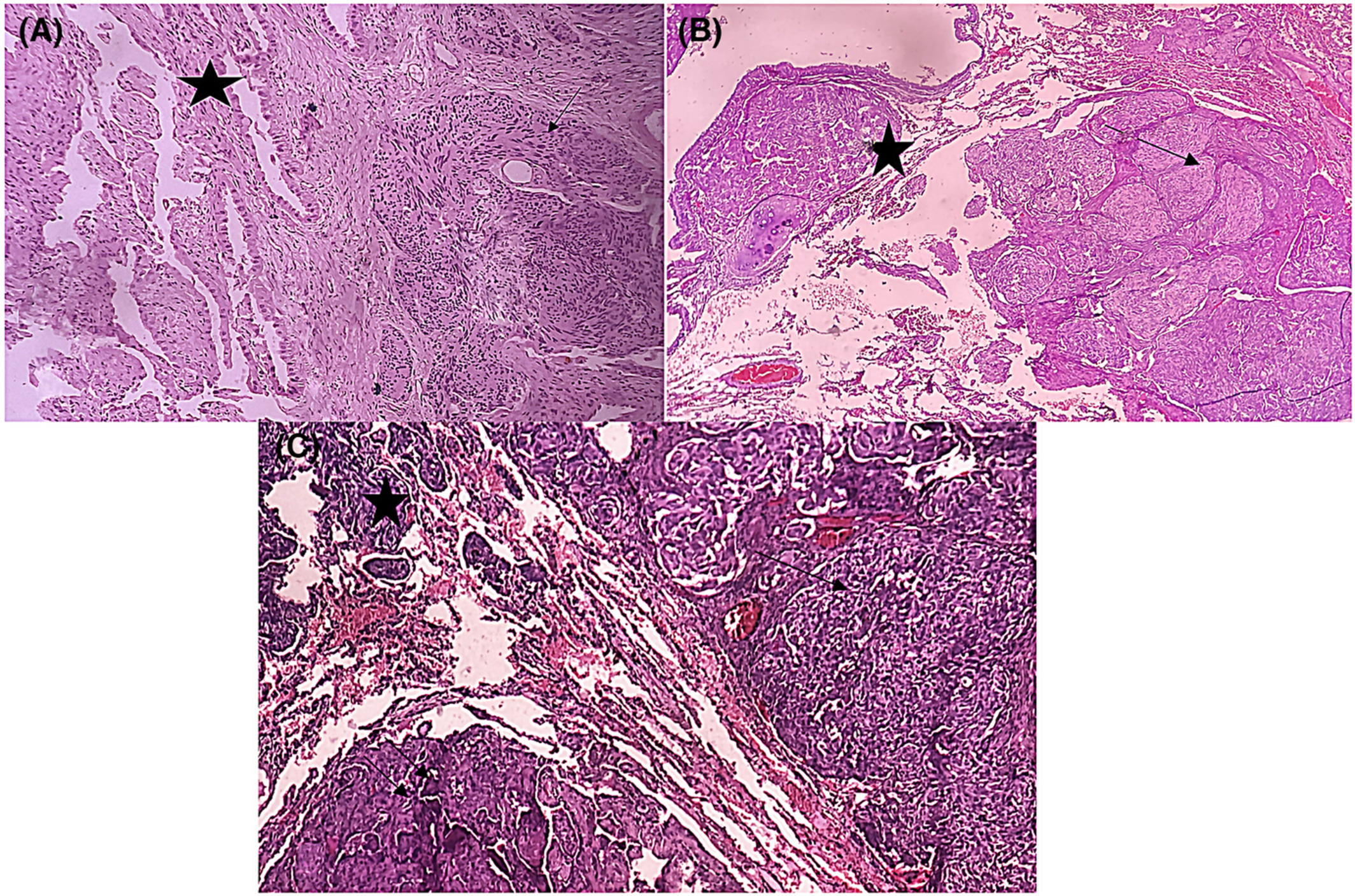 Collision lung tumor associating typical carcinoid tumor to sclerosing hemangioma