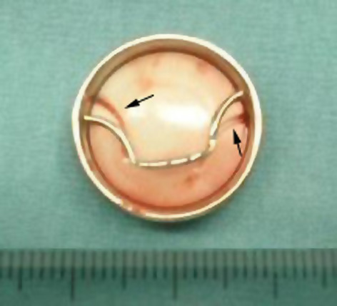 A worn Björk–Shiley prosthetic valve without valve dysfunction observed during ascending aortic replacement