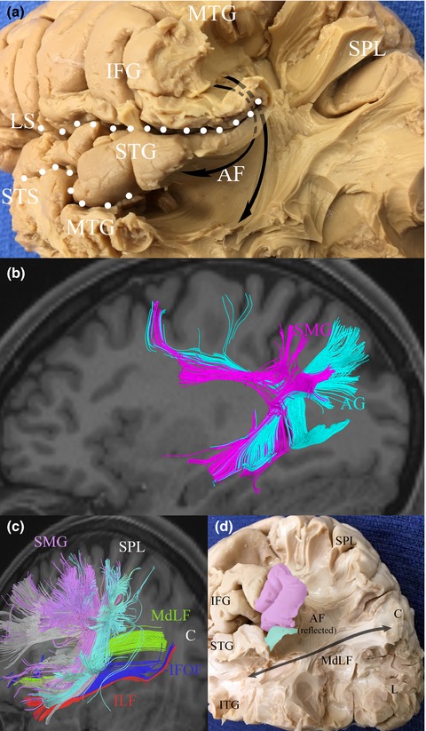 White matter connections of the inferior parietal lobule: A study of surgical anatomy