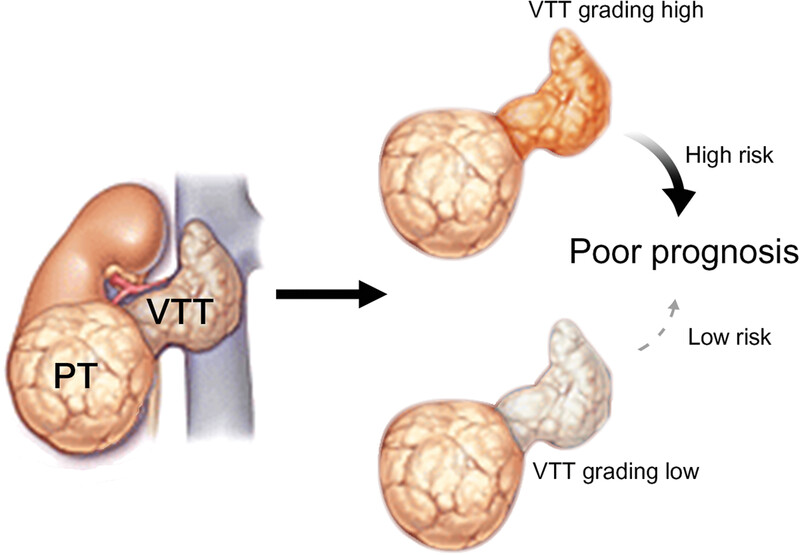 Development and validation of a prognostic model incorporating tumor thrombus grading for nonmetastatic clear cell renal cell carcinoma with tumor thrombus: A multicohort study