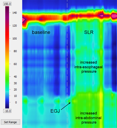 Straight leg raise metrics on high-resolution manometry associate with esophageal reflux burden