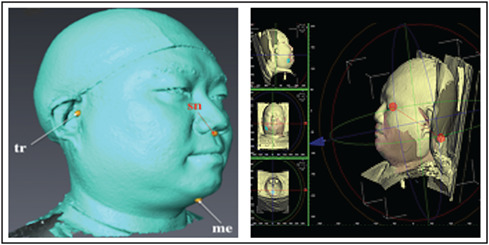 Three-dimensional photography for the evaluation of facial profiles in obstructive sleep apnoea