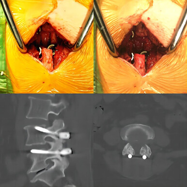 Safety and Efficacy of Cortical Bone Trajectory Screw Fixation Combined with Facet Fusion for the Treatment of Lumbar Degenerative Disease
