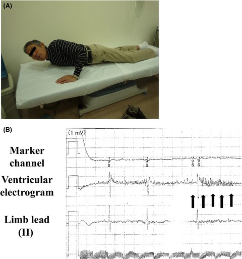Myopotential oversensing notified by Lead Integrity Alert in a patient with implantable cardioverter defibrillator with a dedicated bipolar epicardial sensing lead