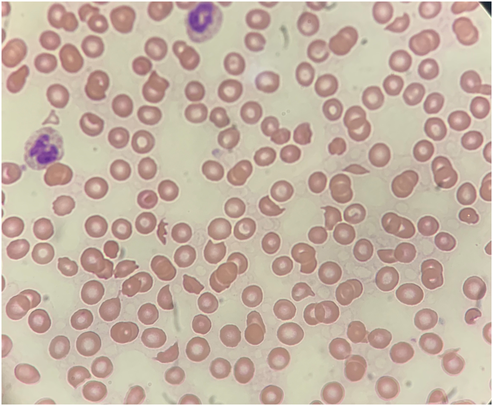 COVID-19-induced thrombotic microangiopathy: A great mimicker of thrombotic thrombocytopenic purpura (TTP)