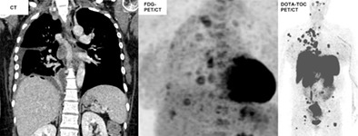 The rarest of rare cases within the one thousand faces of atypical carcinoid: Pseudomesotheliomatous manifestation in a pregnant woman