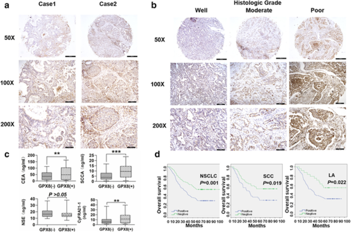 GPX8 promotes migration and invasion by regulating epithelial characteristics in non-small cell lung cancer