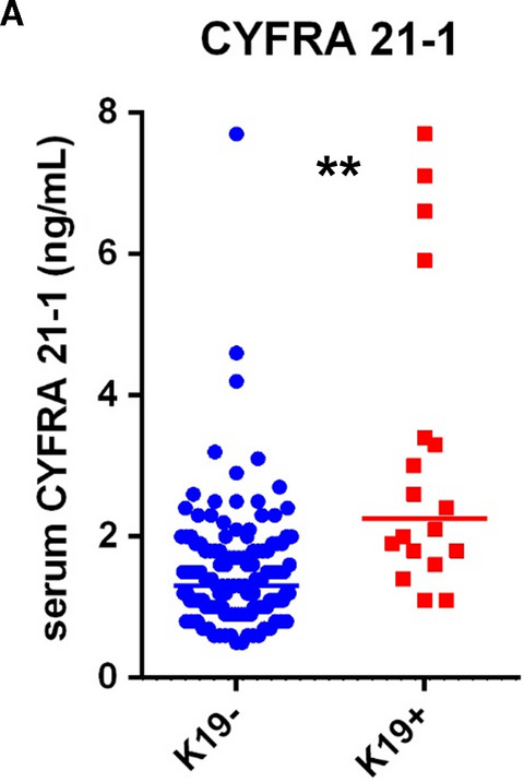 Identification of keratin 19-positive cancer stem cells associating human hepatocellular carcinoma using CYFRA 21-1