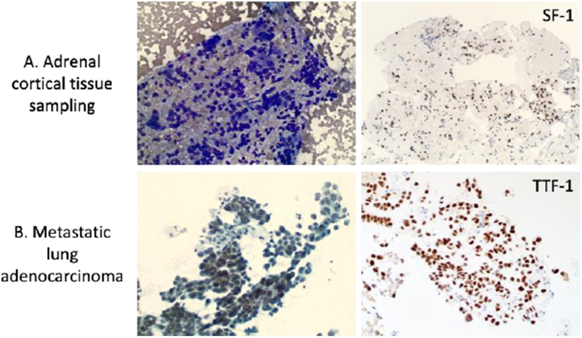 Fine-Needle Aspiration Biopsy of Adrenal Gland Lesions: The Roles of Image Guidance, Rapid On-Site Evaluation and Additional Tissue Sampling