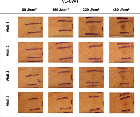 Long-wavelength Ultraviolet A1 and Visible Light Photoprotection: A Multimodality Assessment of Dose and Response