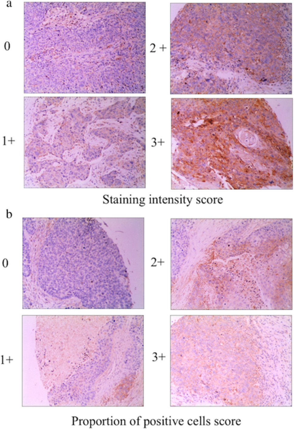 Matrix metalloproteinase-14 (MMP-14) downregulation inhibits esophageal squamous cell carcinoma cell migration, invasion, and proliferation