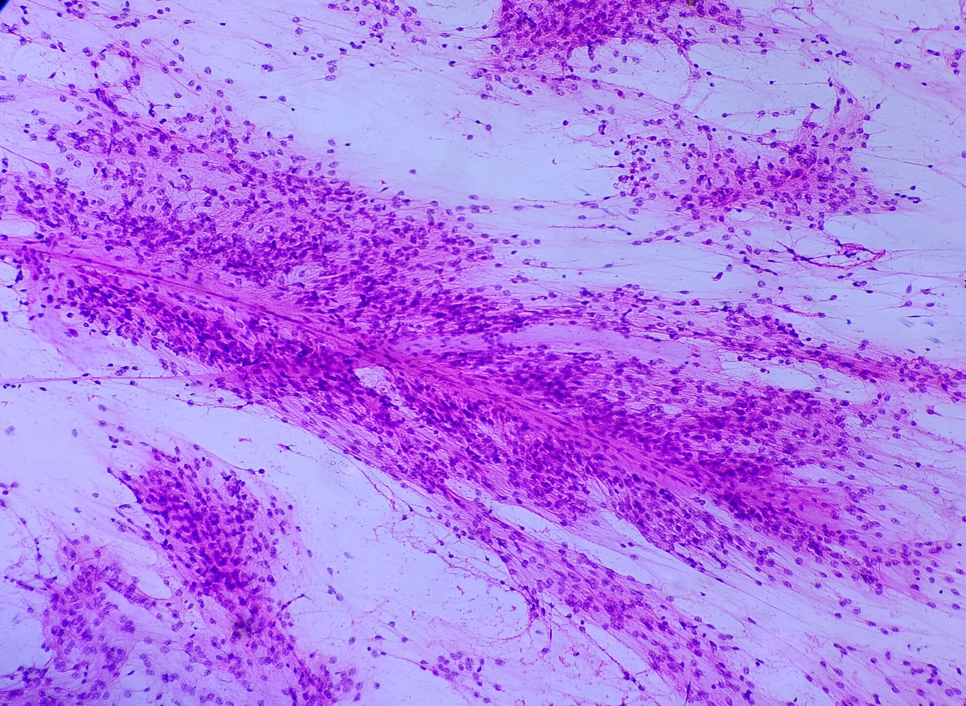 Optic nerve pilomyxoid astrocytoma: Intraoperative squash smear cytology of a rare entity