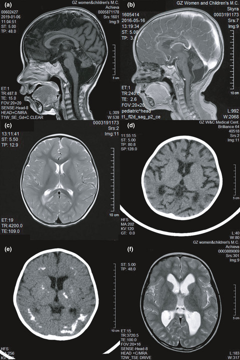 Brain imaging features of children with Hoyeraal-Hreidarsson syndrome