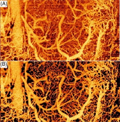 Deep-learning-based motion correction in optical coherence tomography angiography