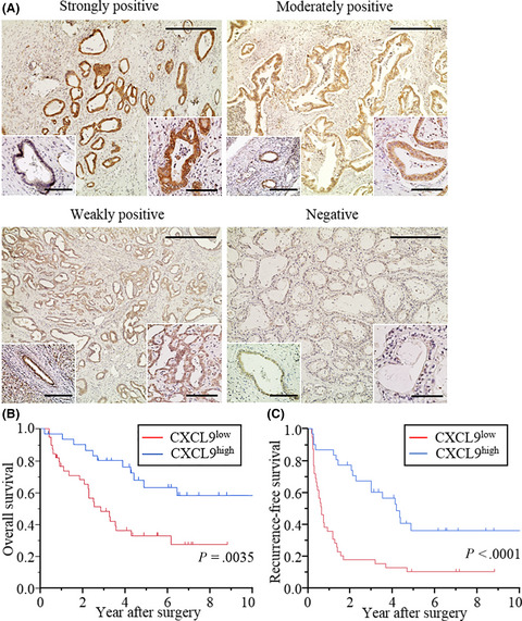 Endogenous CXCL9 affects prognosis by regulating tumor-infiltrating natural killer cells in intrahepatic cholangiocarcinoma