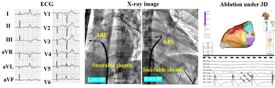 The comparison between the novel technique and conventional method in the catheter ablation of premature ventricular contractions originating from the free wall of tricuspid annulus