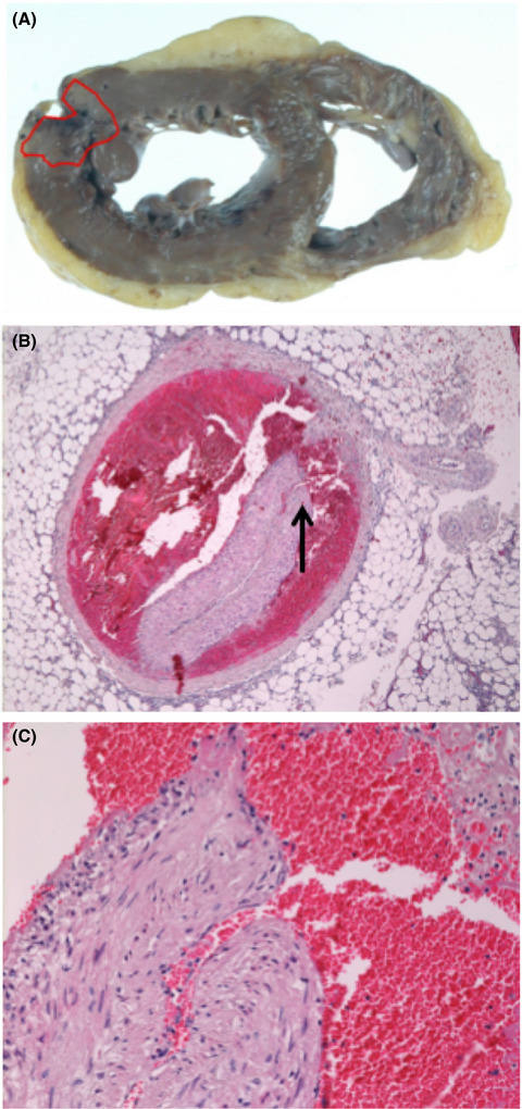 De novo recurrent spontaneous coronary artery dissection in nonatherosclerotic elderly woman: A case report