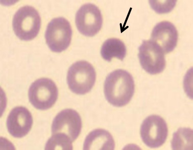 Glucose-6-phosphate dehydrogenase deficiency: not exclusively in males